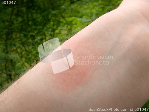 Image of Mosquito bite