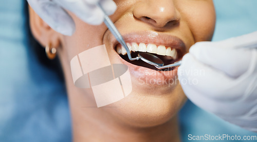 Image of Dentist, mirror and hands, patient mouth and medical tools, surgery and dental health. Tooth decay, healthcare and people at orthodontics clinic for oral care, metal instrument and gingivitis