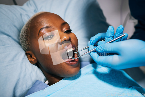 Image of Healthcare, teeth and black woman with dental procedure, surgery and wellness in a hospital bed. Female person, lady and patient with medical equipment, recovery and check up with tooth whitening