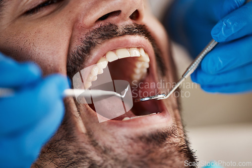 Image of Mouth, man and hands of dentist with tools for dental, healthcare or check in clinic. Oral wellness, orthodontics and patient with doctor, mirror and excavator for teeth cleaning and medical hygiene