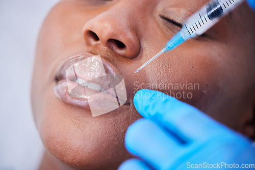 Image of Plastic surgery, needle and black woman with lip filler closeup on a hospital bed with dermatology. Surgeon, facial change and for skincare, cosmetics and wellness in a clinic with doctor hand