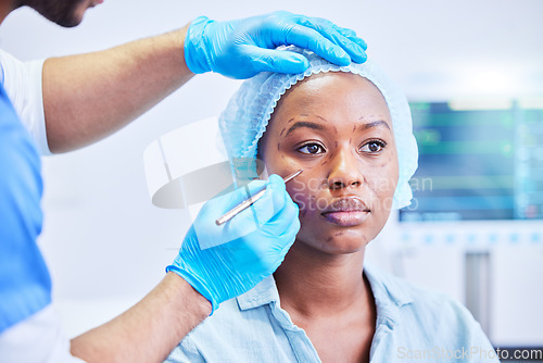 Image of Plastic surgery, pen and black woman in a hospital with dermatology with beauty aesthetics therapist. Surgeon, facial change and filler for skincare, cosmetics and wellness in a clinic with doctor