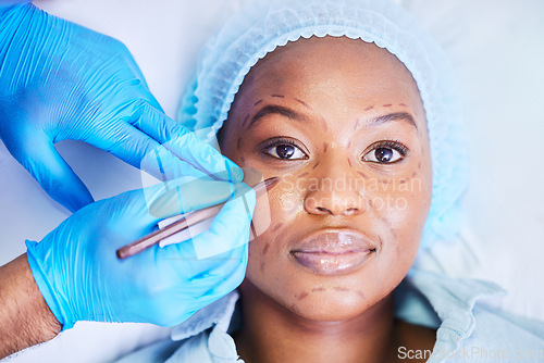 Image of Plastic surgery, pen and black woman portrait on a hospital bed with dermatology with face mark. Surgeon, facial change and medical filler for skincare, cosmetics and wellness in clinic with doctor