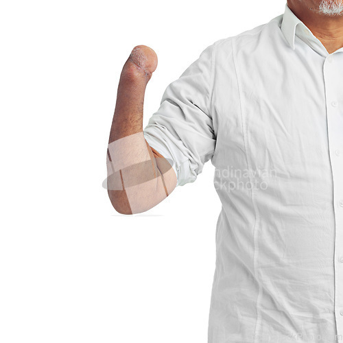 Image of Disability, injury and arm of an injured amputee isolated on a white background in studio. Disabled, defect and body limb of a disabled man or person showing a forearm stump on a studio background