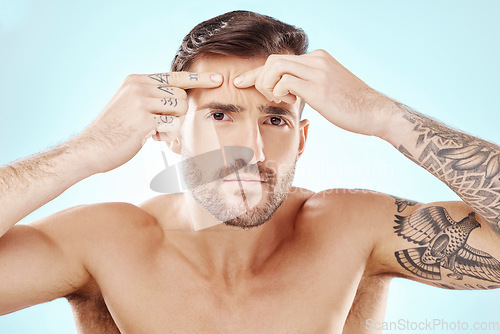 Image of Face, portrait and skin of man with acne or pimple problem with dermatology for self care studio. Frustrated or angry person with hands to press spot for skincare facial wellness on blue background