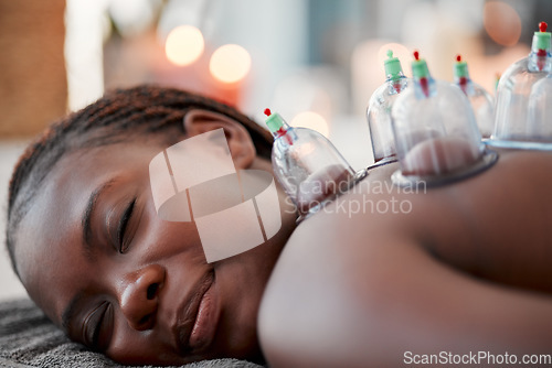 Image of Black woman, face and smile in cupping therapy on back for pain relief, relaxation or blood flow at resort. Happy African American female smiling in relax for glass vacuum cups in deep tissue massage