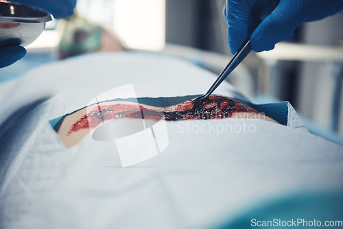 Image of Wound surgery, hand and patient operation, hospital emergency or doctor healing client anatomy, body or injury cut. Closeup medical tools, blood or medical surgeon saving life of person with tweezers