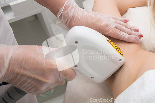 Image of Laser epilation of armpits