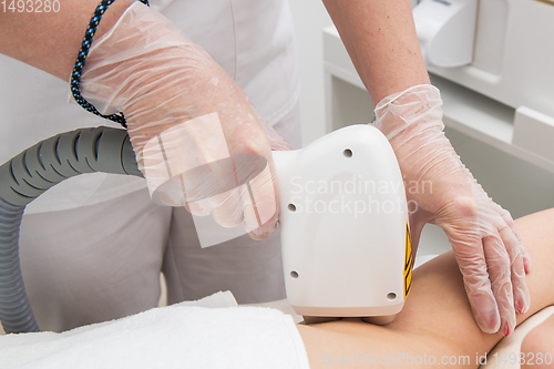 Image of Laser epilation of armpits