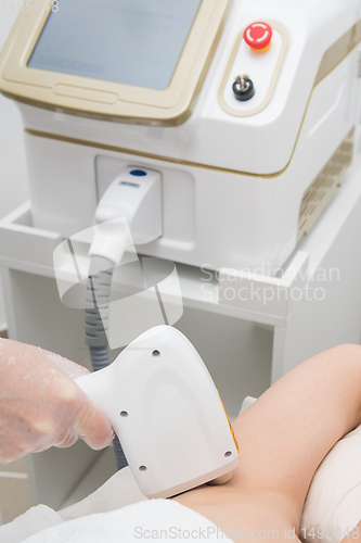 Image of Laser epilation of armpits