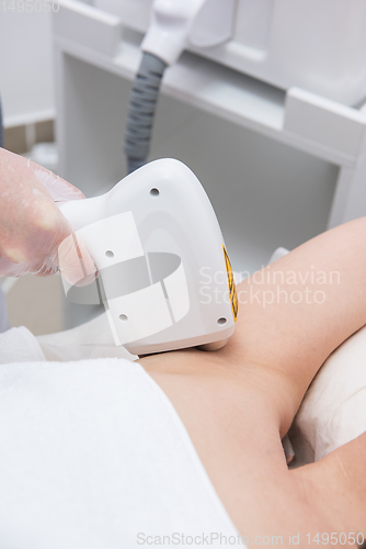 Image of Laser epilation of armpits