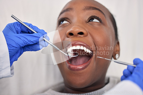 Image of Dentist hands, patient mouth and tools, check teeth for dental health and medical treatment. Oral hygiene, healthcare and orthodontics, black woman with tooth decay and clean for cavity and excavator