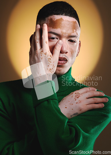 Image of Vitiligo, man face and fashion model portrait for luxury beauty, style and designer brand. Skin pigmentation, hand pose and model posing for expensive clothing with creative and stylish light