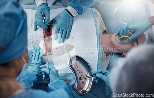 Image of Top view, teamwork of doctors and surgery of patient in hospital. Healthcare, collaboration and group of people or medical professionals performing a surgical operation on man in operation theater.
