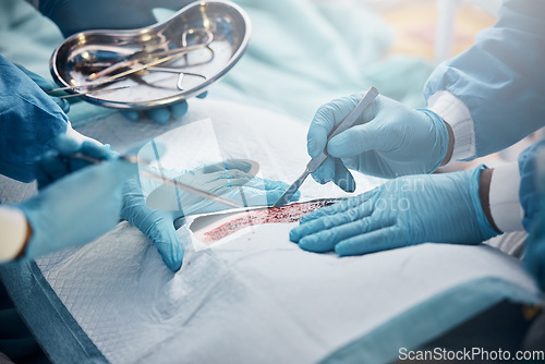 Image of Doctors, nurses or surgery hands on cut patient in hospital emergency room for stomach ulcer, heart attack or burst appendix. Zoom, healthcare workers or surgical operation and steel metal equipment