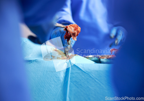 Image of Hands, surgery and cancer with doctors in a hospital to remove a tumor closeup during a medical procedure. Healthcare, medicine and operation with a surgeon team in a clinic for emergency transplant