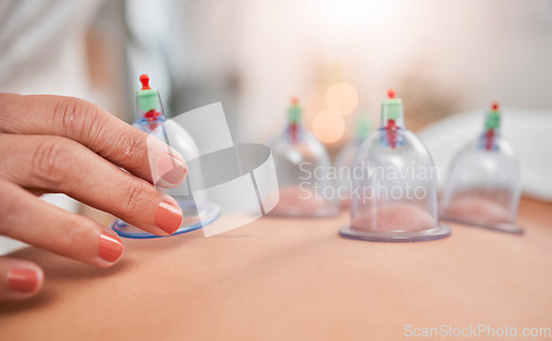 Image of Cupping therapy, hands and spa, healthcare or clinic wellness, blood healing and skin care zoom. Professional, expert and physical therapy worker with plastic vacuum at zen spa for holistic treatment