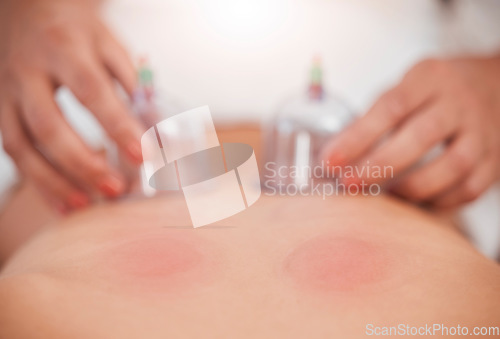 Image of Blood therapy, skincare and cupping for healthcare medical wellness. Peace, luxury physical therapy healing and relax skin physiotherapy with massage therapist hands at spa clinic for calm relaxation