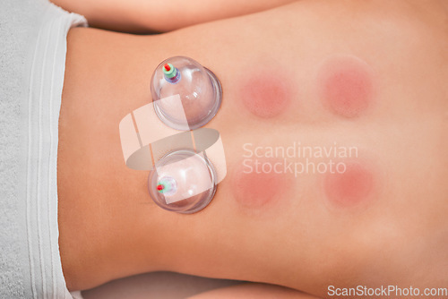 Image of Cupping, therapy and spa with a woman customer lying on a massage table in a beauty center from above. Relax, luxury or wellness with the back of a female in a health center for suction cup treatment