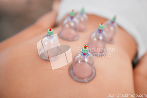 Image of Spa, healthy body and cupping therapy for stress, pain treatment or wellness. Luxury, cup suction or heat to help with pain, deep tissue massage or enhance circulation for health, healing or recovery