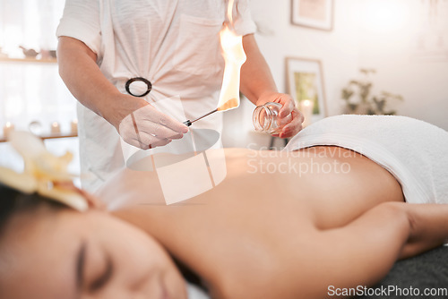 Image of Relax, luxury and woman in cupping therapy for back pain or muscle injury sleeping in peace for physiotherapy. Fire, heating and girl customer with physiotherapist in physical therapy for healing