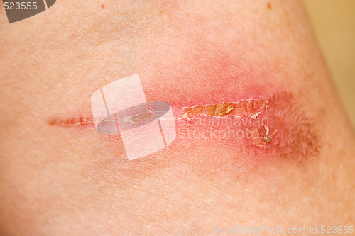 Image of Burn Scar Detail