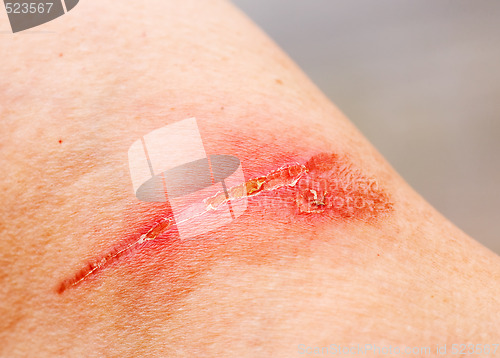 Image of Burn Scar