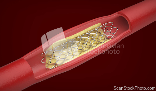 Image of Medical stent inside blood vessel