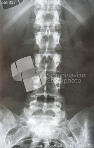 Image of X-ray