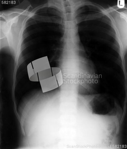 Image of Chest x-ray