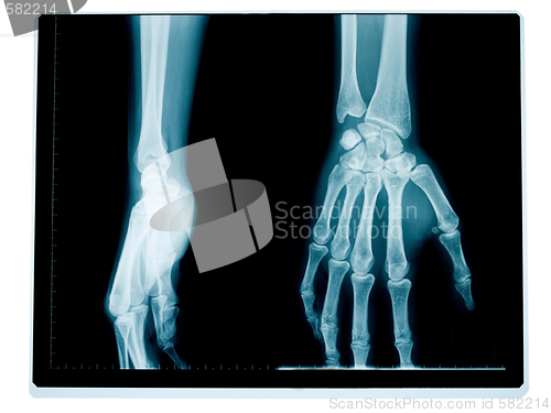 Image of Hand and wrist radiography