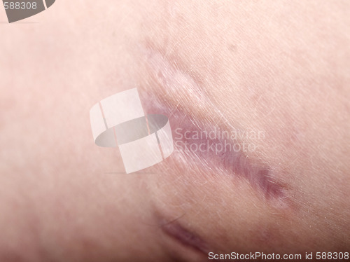 Image of scar