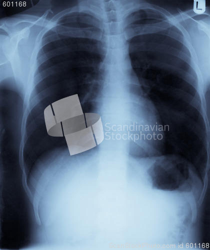 Image of Chest x-ray