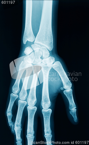 Image of Hand x-ray