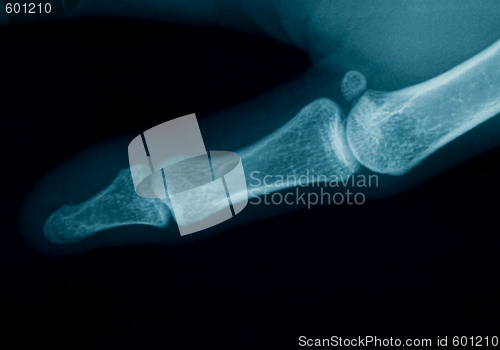 Image of Finger  x-ray