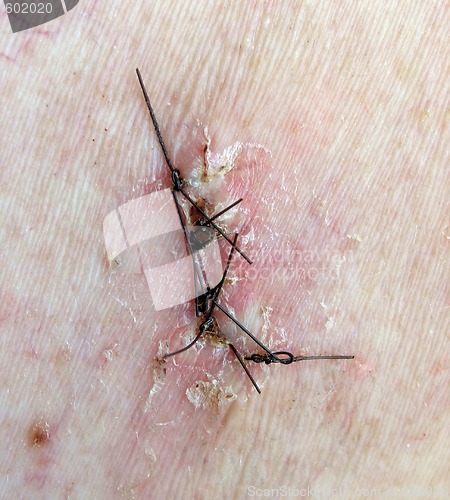 Image of surgical sutures