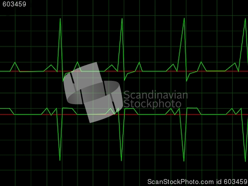 Image of Normal Heart Rhythm