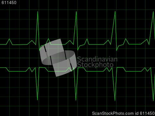 Image of Normal Heart Rhythm