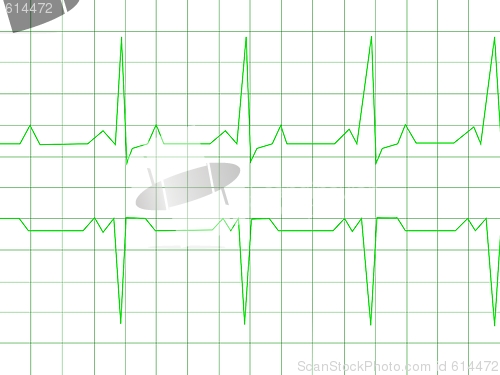 Image of Normal Heart Rhythm