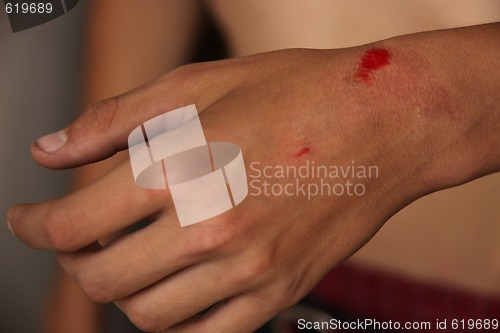 Image of Bleeding Scraped Wrist