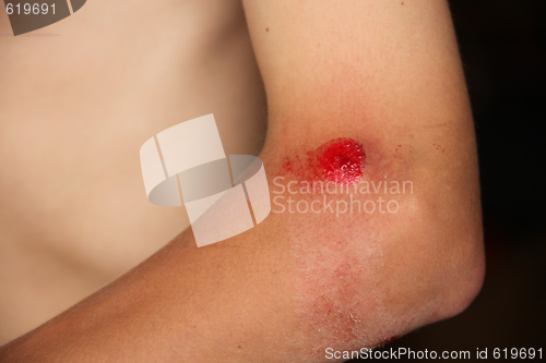 Image of Scraped Up Bleeding Elbow