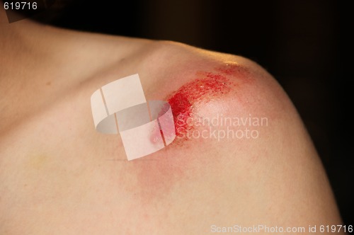 Image of Bleeding Shoulder Injury