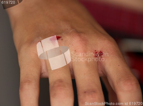 Image of Injured Bleeding Hand