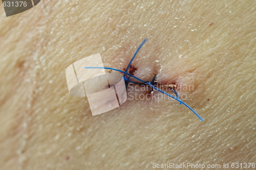 Image of Birth mark
