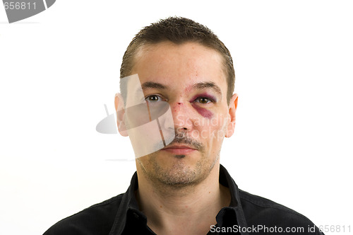 Image of broken nose and black eye