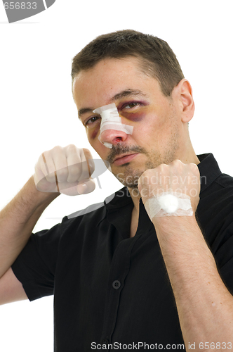 Image of broken nose post operation