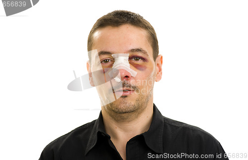 Image of broken nose and black eyes post operation