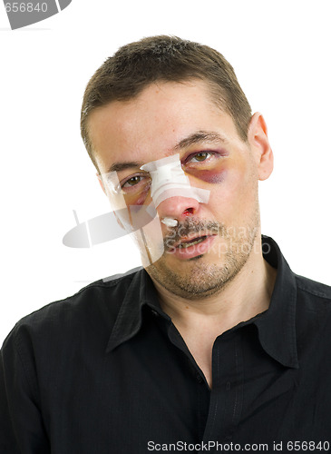Image of broken nose and black eyes post operation