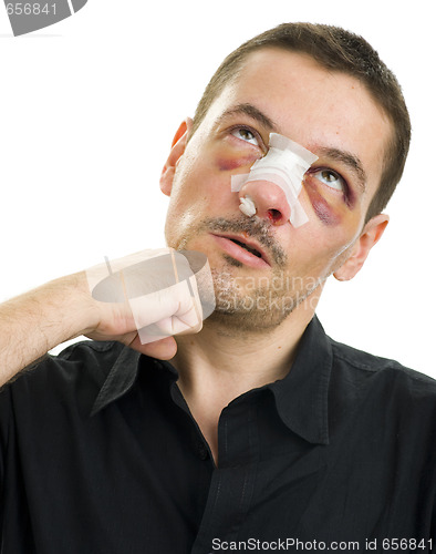 Image of broken nose post operation