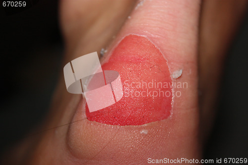 Image of blister